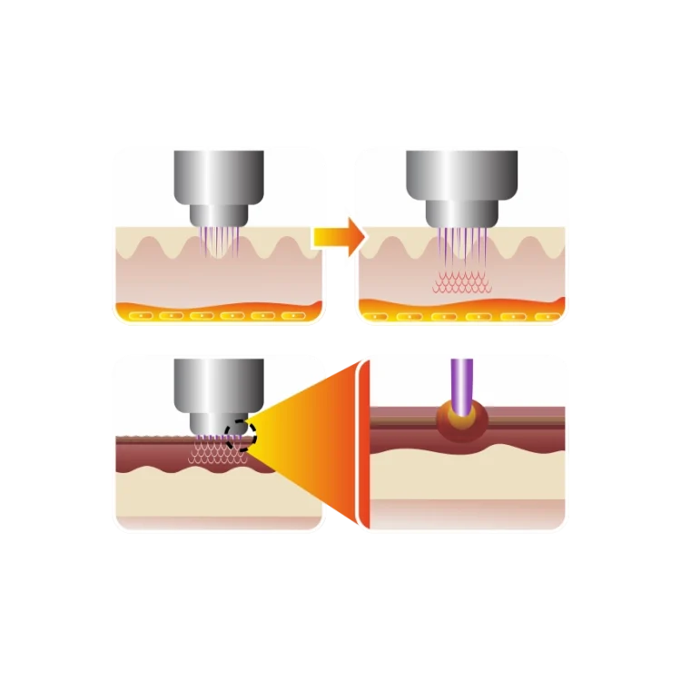 pinacle-rf-basligi-teknik-atum-medikall